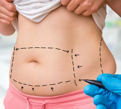Targeted Fat Reduction with the Kybella